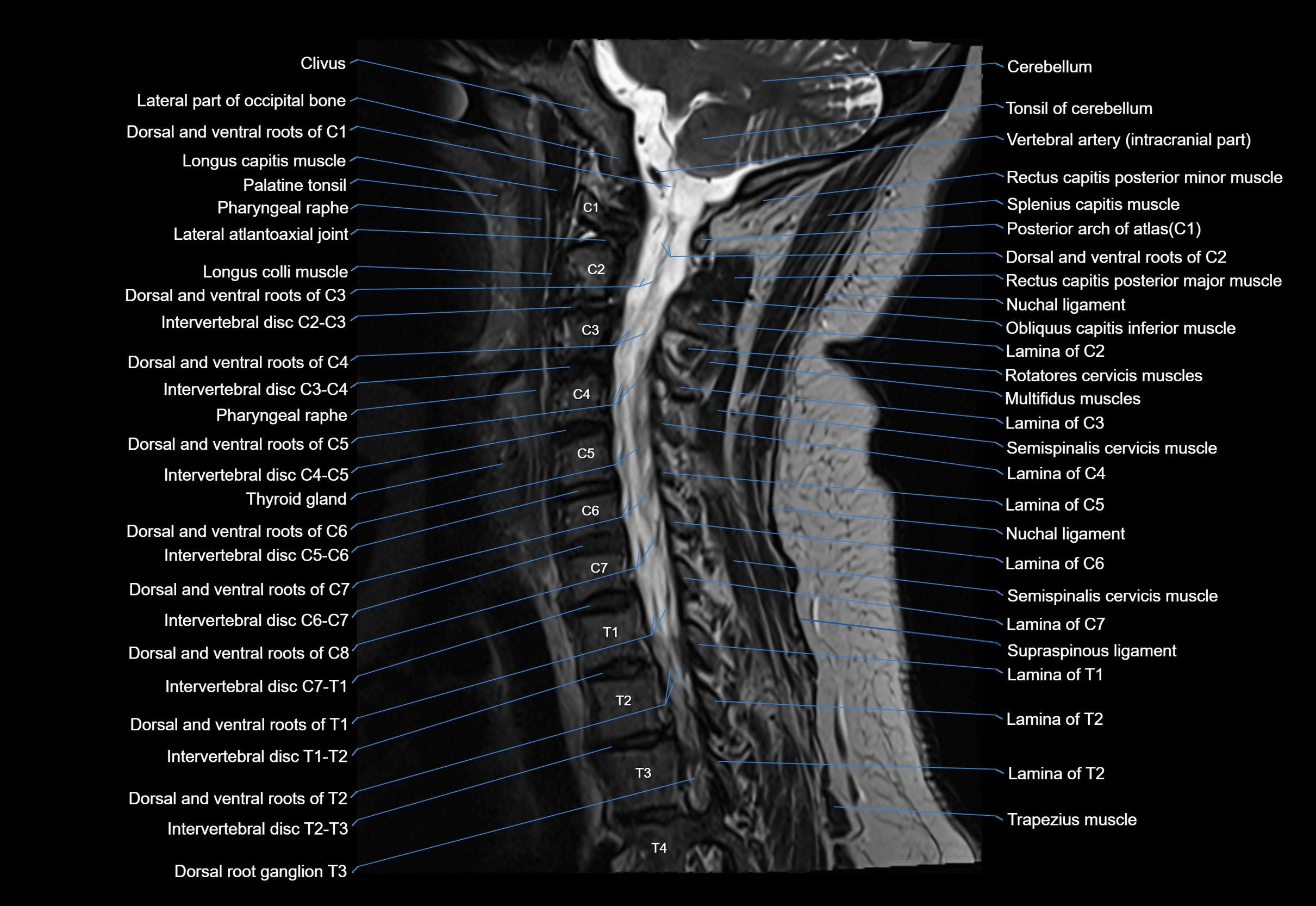 cervical spine cross sectional MRI anatomy 3T MRI  sagittal image-img-00001-00013.webp